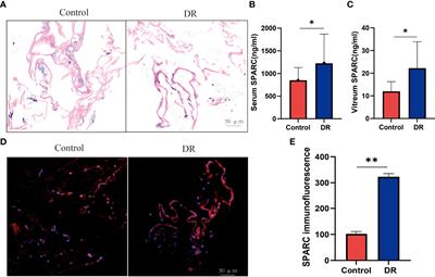 Secreted Protein Acidic and Rich in Cysteine Mediates the Development and Progression of Diabetic Retinopathy